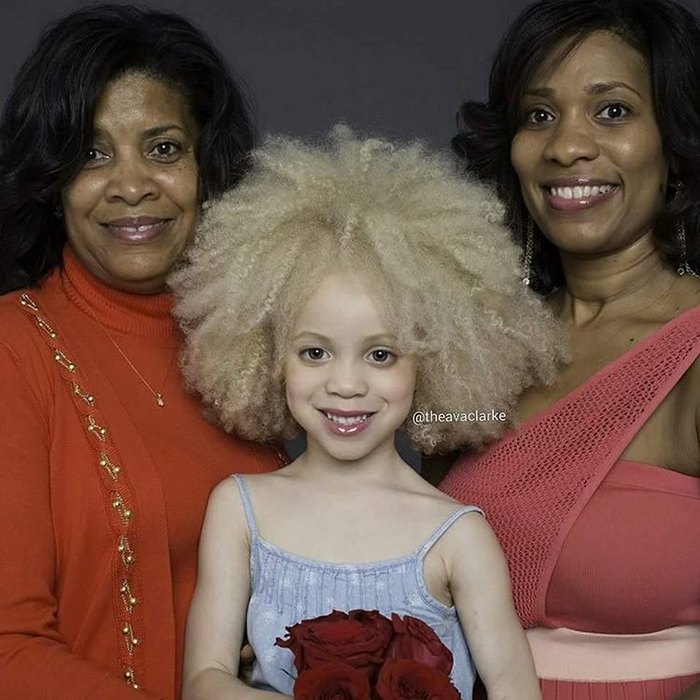 Un giovane albino afro-americano dal viso angelico conquista il mondo della moda