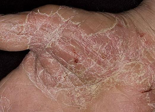 Eczema: cosa trattare?