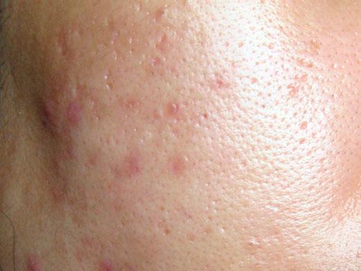 Come sbarazzarsi di tracce di acne?