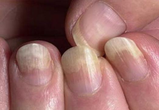 Come curare i funghi delle unghie?