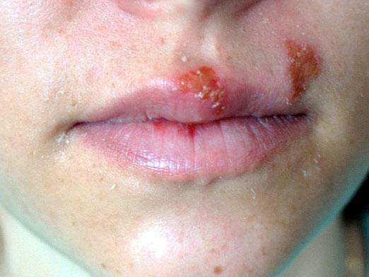 Che per curare l'herpes?