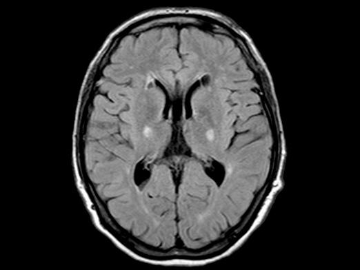 Cos'è la risonanza magnetica cerebrale?